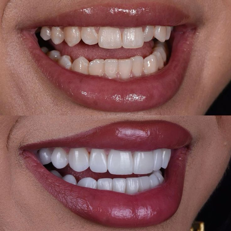 natural veneers | los angeles veneers